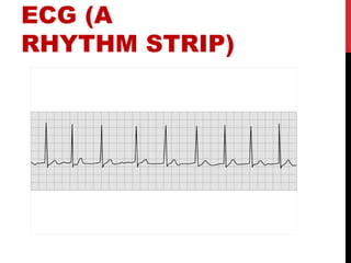 ECG (A
RHYTHM STRIP)
 
