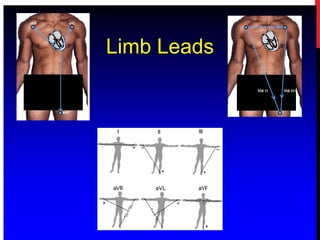 Limb Leads
 