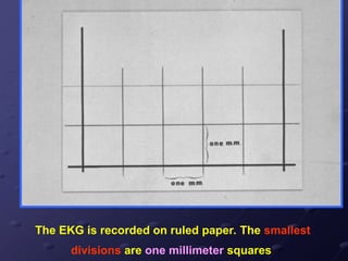 The EKG is recorded on ruled paper. The smallest
divisions are one millimeter squares
 