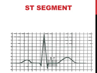 ST SEGMENT
Elevation or depression of the ST
segment by 0.1 mV from the baseline
is abnormal
 