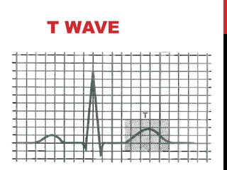 T WAVE
 