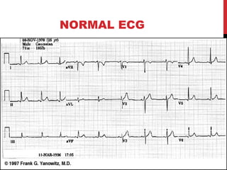 NORMAL ECG
 