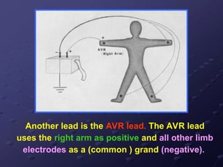 Another lead is the AVR lead. The AVR lead
uses the right arm as positive and all other limb
electrodes as a (common ) grand (negative).
 