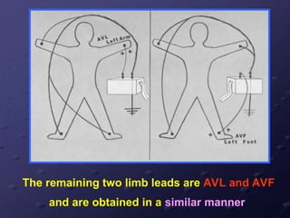 The remaining two limb leads are AVL and AVF
and are obtained in a similar manner
 