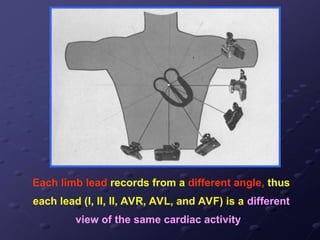 Each limb lead records from a different angle, thus
each lead (I, II, II, AVR, AVL, and AVF) is a different
view of the same cardiac activity
 