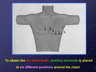 To obtain the six chest leads, positive electrode is placed
at six different positions around the chest
 
