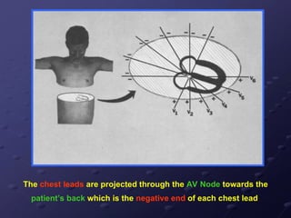 The chest leads are projected through the AV Node towards the
patient’s back which is the negative end of each chest lead
 