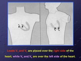 Leads V1 and V2 are placed over the right side of the
heart, while V5 and V6 are over the left side of the heart.
 