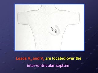 Leads V3 and V4 are located over the
interventricular septum
 