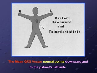 The Mean QRS Vector normal points downward and
to the patient’s left side
 