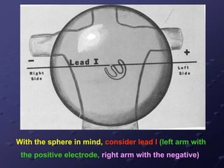 With the sphere in mind, consider lead I (left arm with
the positive electrode, right arm with the negative)
 