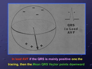 In lead AVF if the QRS is mainly positive one the
tracing, then the Mean QRS Vector points downward
 