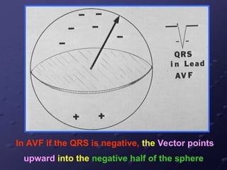 In AVF if the QRS is negative, the Vector points
upward into the negative half of the sphere
 