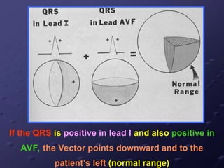 If the QRS is positive in lead I and also positive in
AVF, the Vector points downward and to the
patient’s left (normal range)
 