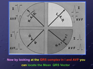 Now by looking at the QRS complex in I and AVF you
can locate the Mean QRS Vector
 