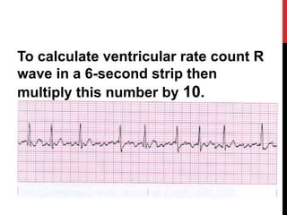 To calculate ventricular rate count R
wave in a 6-second strip then
multiply this number by 10.
 