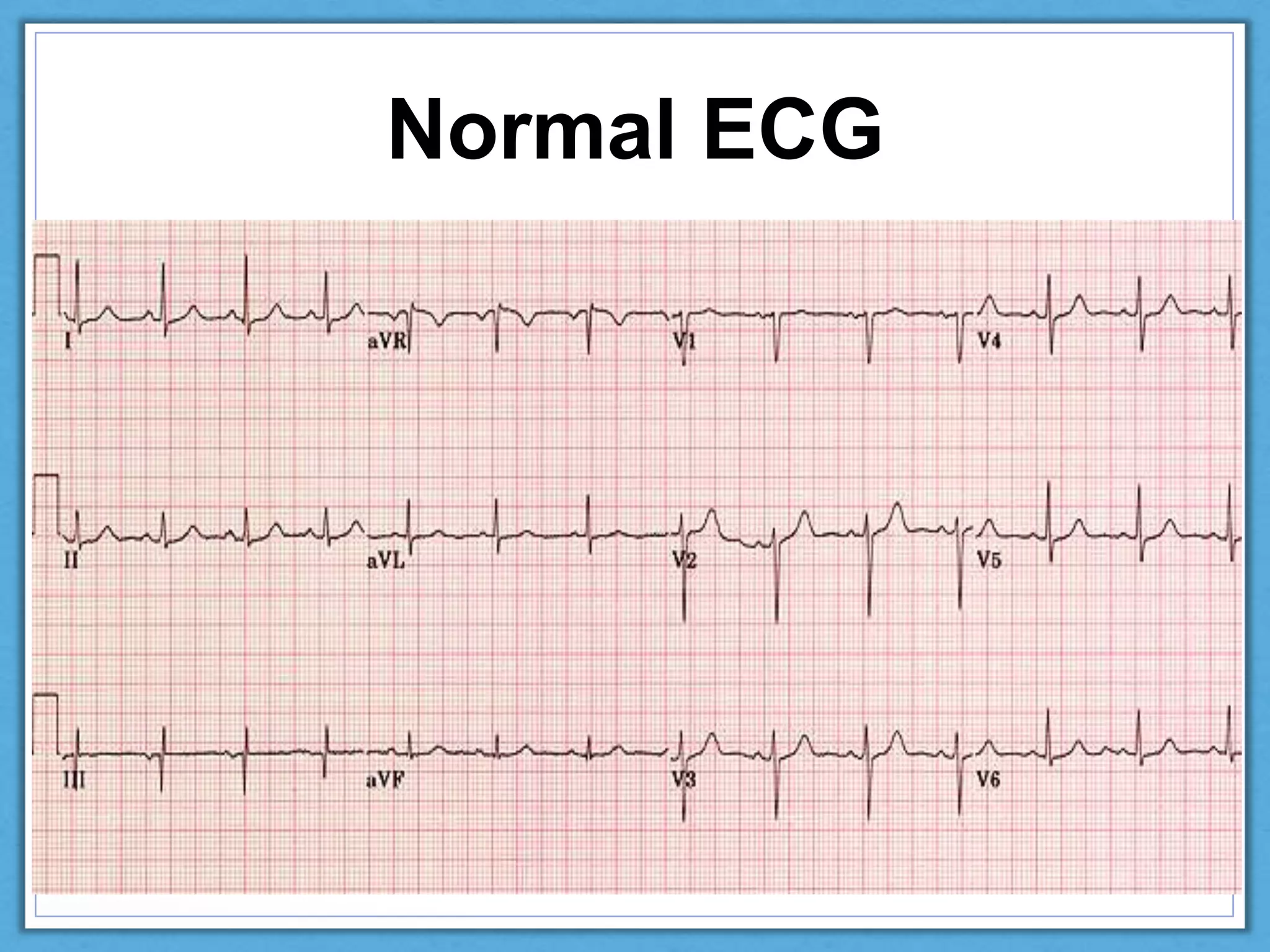 Normal Ecg Interpretation PPTX Normal Ecg Interpretation PPTX