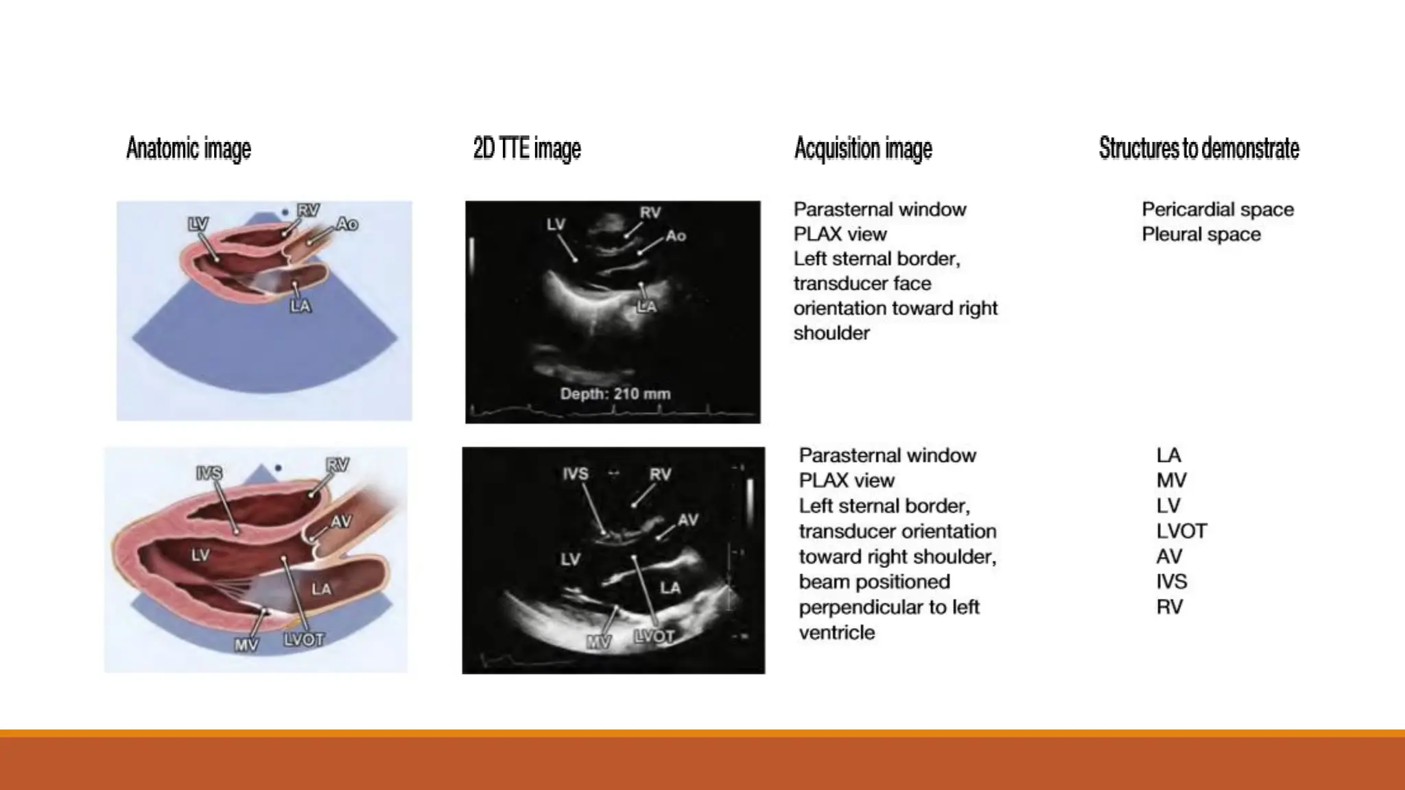 Normal Echocardiogram. Based on cardiac studies