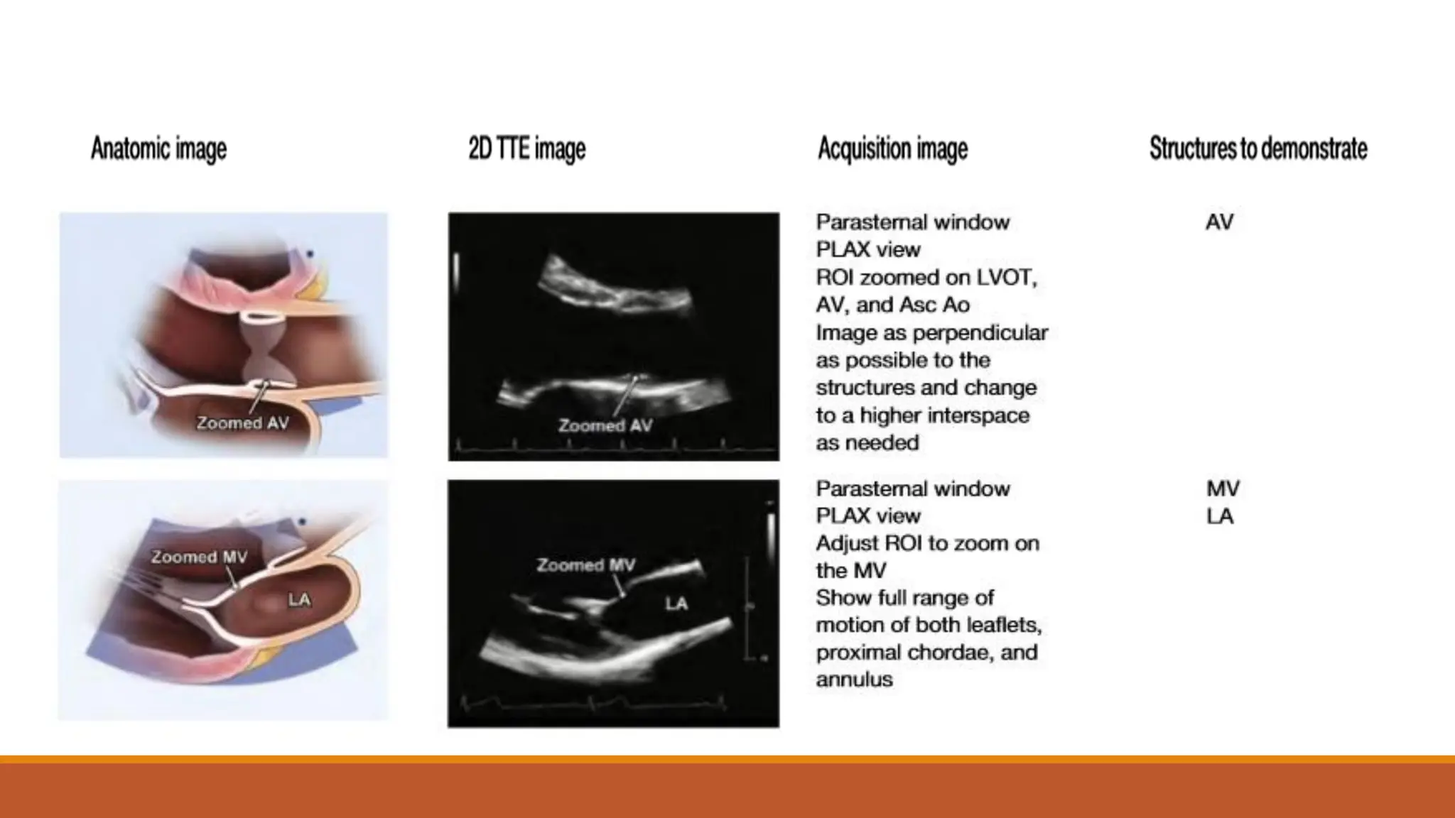 Normal Echocardiogram. Based on cardiac studies