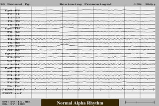 Normal EEG patterns, frequencies, as well as patterns that may simulate ...
