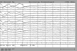 Normal EEG patterns, frequencies, as well as patterns that may simulate ...