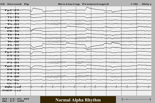 Normal EEG patterns, frequencies, as well as patterns that may simulate ...