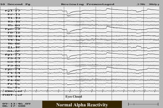 Normal EEG patterns, frequencies, as well as patterns that may simulate ...