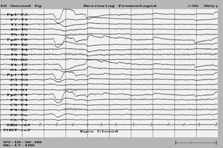 Eeg Spectrum Patterns Normal EEG patterns, frequencies, as well as patterns that may simulate ...