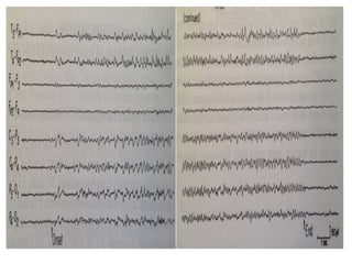 EEG Variants with patterns by Murtaza Syed | PPT