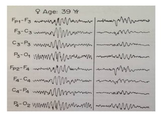 EEG Variants with patterns by Murtaza Syed | PPT