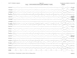 EEG Variants with patterns by Murtaza Syed | PPT