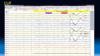 Eeg Wave Form Ranges Normal EEG waveforms.pptx