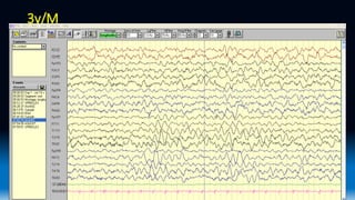 Eeg Wave Form Ranges Normal EEG waveforms.pptx