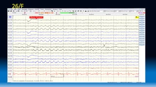 Regular Eeg Waveforms Normal EEG waveforms.pptx