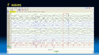 Eeg Wave Form Ranges Normal EEG waveforms.pptx