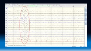 Eeg Wave Form Ranges Normal EEG waveforms.pptx
