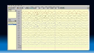 Eeg Wave Form Ranges Normal EEG waveforms.pptx