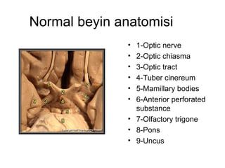 Normal beyin anatomisi 1-Optic nerve  2-Optic chiasma  3-Optic tract  4-Tuber cinereum  5-Mamillary bodies  6-Anterior perforated substance  7-Olfactory trigone  8-Pons  9-Uncus  