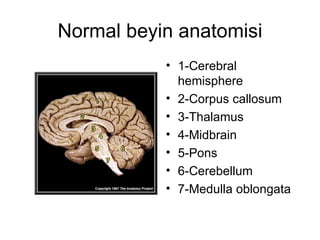 Normal beyin anatomisi 1-Cerebral hemisphere  2-Corpus callosum  3-Thalamus  4-Midbrain  5-Pons  6-Cerebellum  7-Medulla oblongata  