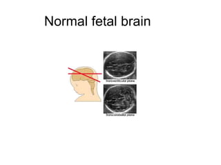 Normal fetal brain  