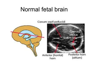 Normal fetal brain 