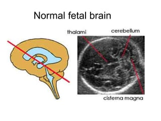 Normal fetal brain 