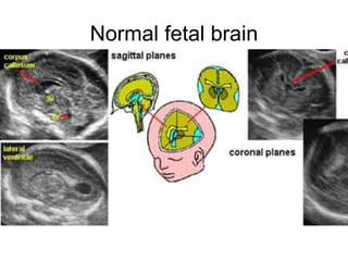 Normal fetal brain 