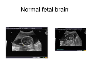 Normal fetal brain 