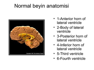 Normal beyin anatomisi  1-Anterior horn of lateral ventricle  2-Body of lateral ventricle  3-Posterior horn of lateral ventricle  4-Inferior horn of lateral ventricle  5-Third ventricle  6-Fourth ventricle  
