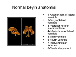 Normal beyin anatomisi 1-Anterior horn of lateral ventricle  2-Body of lateral ventricle  3-Posterior horn of lateral ventricle  4-Inferior horn of lateral ventricle  5-Third ventricle  6-Fourth ventricle  7-Interventricular foramen  8-Cerebral aqueduct  