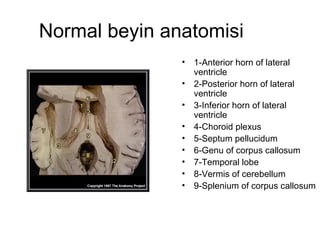 Normal beyin anatomisi  1-Anterior horn of lateral ventricle  2-Posterior horn of lateral ventricle  3-Inferior horn of lateral ventricle  4-Choroid plexus  5-Septum pellucidum  6-Genu of corpus callosum  7-Temporal lobe  8-Vermis of cerebellum  9-Splenium of corpus callosum  
