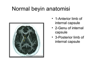 Normal beyin anatomisi 1-Anterior limb of internal capsule  2-Genu of internal capsule  3-Posterior limb of internal capsule  