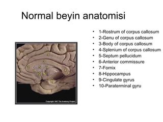 Normal beyin anatomisi 1-Rostrum of corpus callosum  2-Genu of corpus callosum  3-Body of corpus callosum  4-Splenium of corpus callosum  5-Septum pellucidum  6-Anterior commissure  7-Fornix  8-Hippocampus  9-Cingulate gyrus  10-Paraterminal gyru  