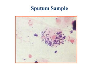 Sputum Sample
 